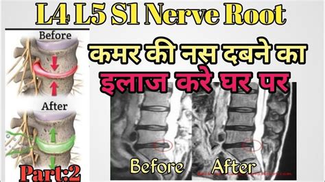 s1 nerve root impingement exercises